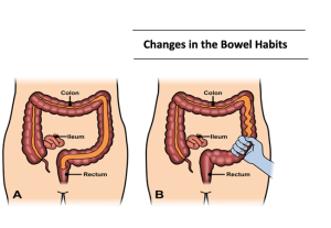 Changes in the Bowel Habits