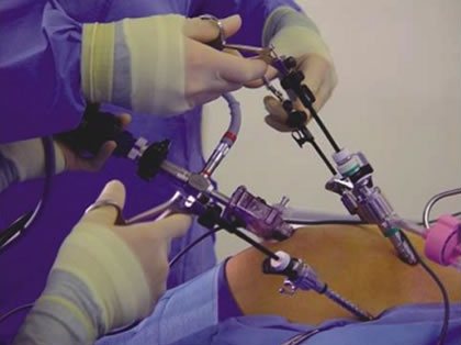 Obesity Surgery in India at Affordable Cost