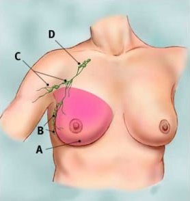 Mastectomy Surgery in India