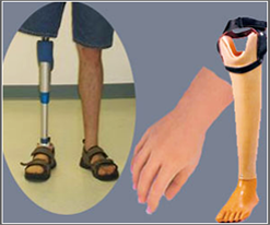 Artificial Limb Prosthesis Surgery India Low Cost Benefits