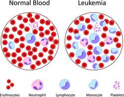 Blood Cancer Surgery in India