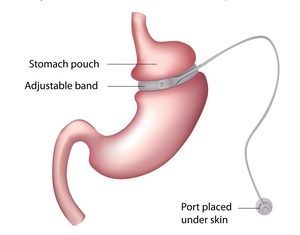 Cost Lap Band Surgery in India