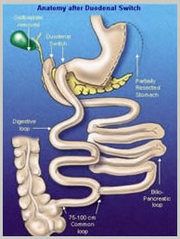 Duodenal Switch Surgery in India