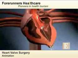 Medical Tourism for your Valve Replacement Surgery in India