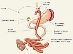 Lap Band Surgery in India