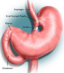 stomach stapling surgery in india